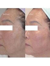 アーネスト 大阪心斎橋店(EARNEST)/水光ピーリング【 シミくすみ 】