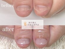 深爪矯正 爪悩み専門店 cocomo/(深爪/長さだし/フィルイン)