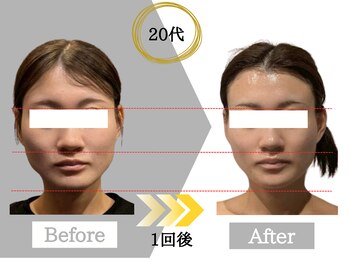 ジャパ(JAPA)/NRフェイシャルで超小顔に!!