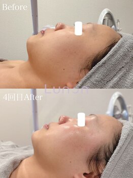 ルノン(Lunon)/毛穴洗浄ハイドロ×ララピール