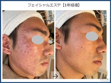 ひかり素肌/フェイシャルエステ1年間