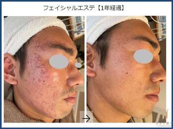ひかり素肌/フェイシャルエステ1年間