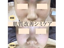 パルサロン(palsalon.)の雰囲気（パルサロンのシミケアは肌質改善も叶う！）