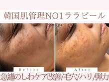 Cスキンケアクリニック 麻布店/ララピールBeforeAfter #東麻布