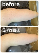 ギンザアール(GINZA R.)/二の腕に徹底アプローチ◎