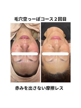 ヒール(heal)/フェイスライン、しみ、シワ悩み