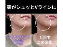 目元 口元のたるみ 眉間シワ改善専門サロン/フェイスラインをシュッとしたい