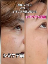 スプーンサロン(SPOON SALON)/シミケア