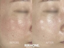 ネオリー(neorii)/水光ピーリング