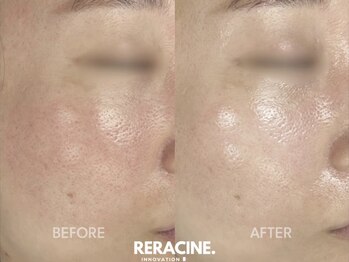 ネオリー(neorii)/水光ピーリング