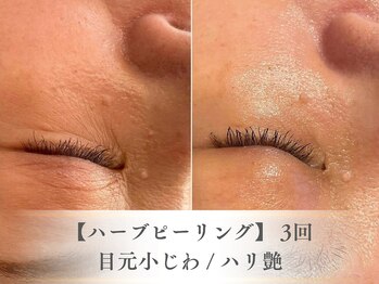 ベルペール(Belle perle)/【ハーブピーリング】毛穴/シミ