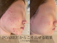 ポアレ(POARE)
