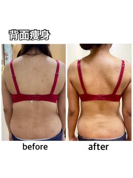 エステティックレイビス 名古屋店(RAYVIS)/背中美人♪