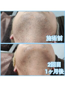 マイセルフ(myself)/ヒゲ脱毛施術例：30代