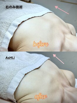 アシュリー 表参道(AsHLi)/ふっくらバストBBL