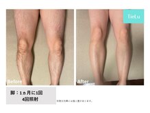 ティエル(TieLu)/足脱毛