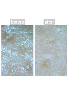 トランク(Trunk)/ハイドラ→プラズマフェイシャル