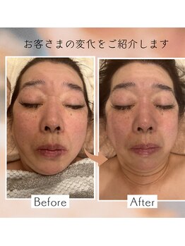 クレビア(CREBIA)/たるみ・リフトアップに◎