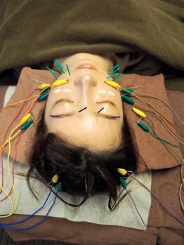 ビハダ(BIHADA)/微弱電流×美容鍼で小顔に！