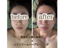 スカイ(sky)/頭蓋骨矯正×ハーブピーリング