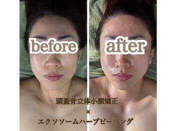 スカイ(sky)/頭蓋骨矯正×ハーブピーリング