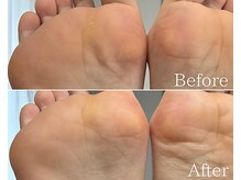 カシェット 広島店(Cachette)/30代女性☆足裏角質ケア90分