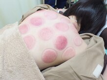 すずらん接骨院の雰囲気（人気メニュー、カッピングで肩こり、腰痛、むくみ等を解消！！）