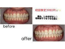 歯のホワイトニング　Salon E'clatの雰囲気（回数を重ねるごとにさらに美しい口元へ♪）