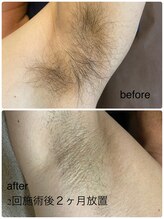 エイチ(H)/メンズ　脇脱毛