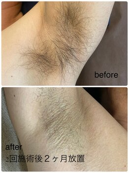 エイチ(H)/メンズ　脇脱毛