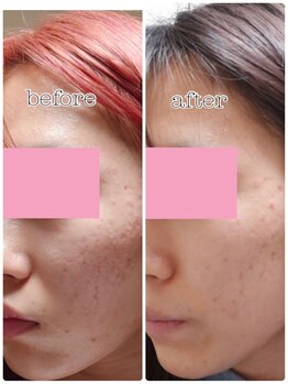 アロマ&クレイケアルーム ネロリドール(Nerolidol)/毛穴、ニキビケアにクレイ