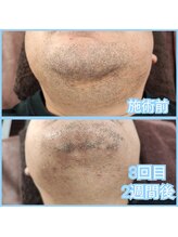 マイセルフ(myself)/ヒゲ脱毛施術例：30代