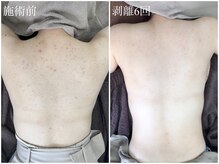 エミルカ(EMILUCA)/ハーブピーリングで背中綺麗に！