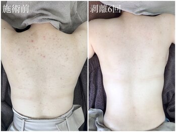 エミルカ(EMILUCA)/ハーブピーリングで背中綺麗に！