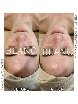 サロン ド ブラン アオヤマ(Salon de BLANC AOYAMA)/シワ改善&ほうれい線改善