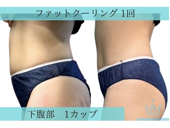 リメイククリニカルビューティー(Remake clinical beauty)/下腹撃退