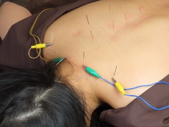 リッチョ鍼灸院(Riccio鍼灸院)/首・肩こり・腰痛 鍼灸施術