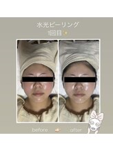 エクボ(EcBeau)/PHA水光ピーリング肌管理水光肌