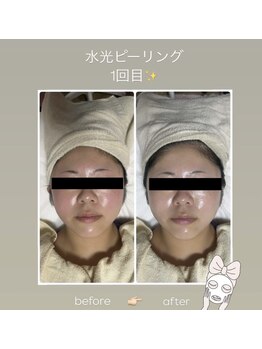 エクボ(EcBeau)/PHA水光ピーリング肌管理水光肌