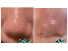 カラーリリー(calla lily)/毛穴美肌フェイシャル