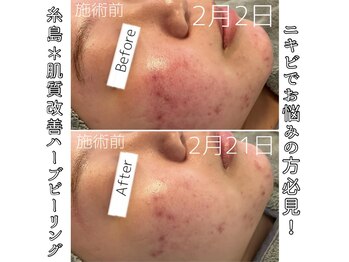 エヌプラス(N+)/20代女性＊ピーリング1回後