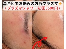 ベルファーム(Belle Femme)/プラズマシャワーで肌荒れ改善へ