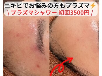 ベルファーム(Belle Femme)/プラズマシャワーで肌荒れ改善へ