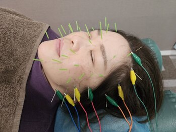 越谷マックス鍼灸整骨院/特殊な極細の鍼を使用し肌質改善