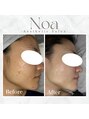 ノア 新宿(Noa)&nbsp;ニキビ 改善