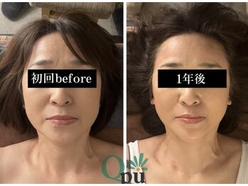 キュープ 富士店(Qpu)の写真/小顔×美肌でたるみ改善♪若々しい印象へと導きます!ハリ・ツヤUP*