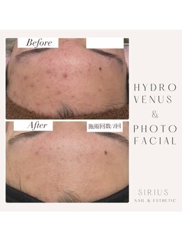 シリウス(Sirius)/ハイドロ+光フィシャル