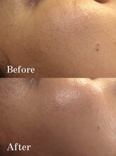 エアレ(eare)/REVlビフォーアフター