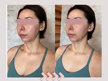 サリー(Sally)/顔の肥大化ストップ