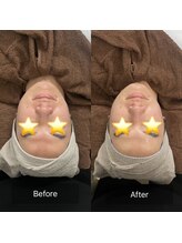 トニック バイ まつもと整骨院鍼灸院(Tonic)/★Before After★豊中／毛穴